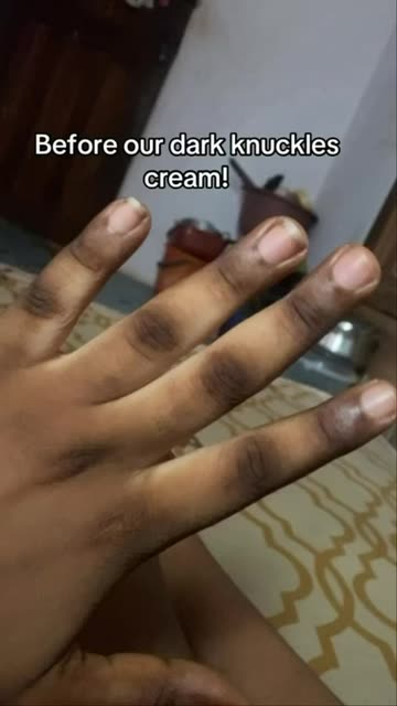glutathione for dark knuckles paminify 5.2oz Knuckle Whitening Cream,Skin Body Bleaching Dark Knees and Elbows,Moisturizing Strong Joint Whitening Cream for Clavicle,Neck,Niacinamide Vitamin C Dark Spot Corrector Remover : Beauty & Personal Care Dark Knuckles: Causes, Treatments, and